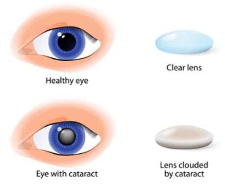 Cataracts