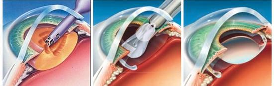 Phacoemulsification Surgery